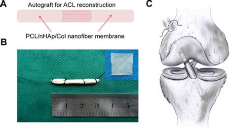  NanoHydroxyapatite: Tái tạo xương và vật liệu đột phá trong kỹ thuật y tế hiện đại?